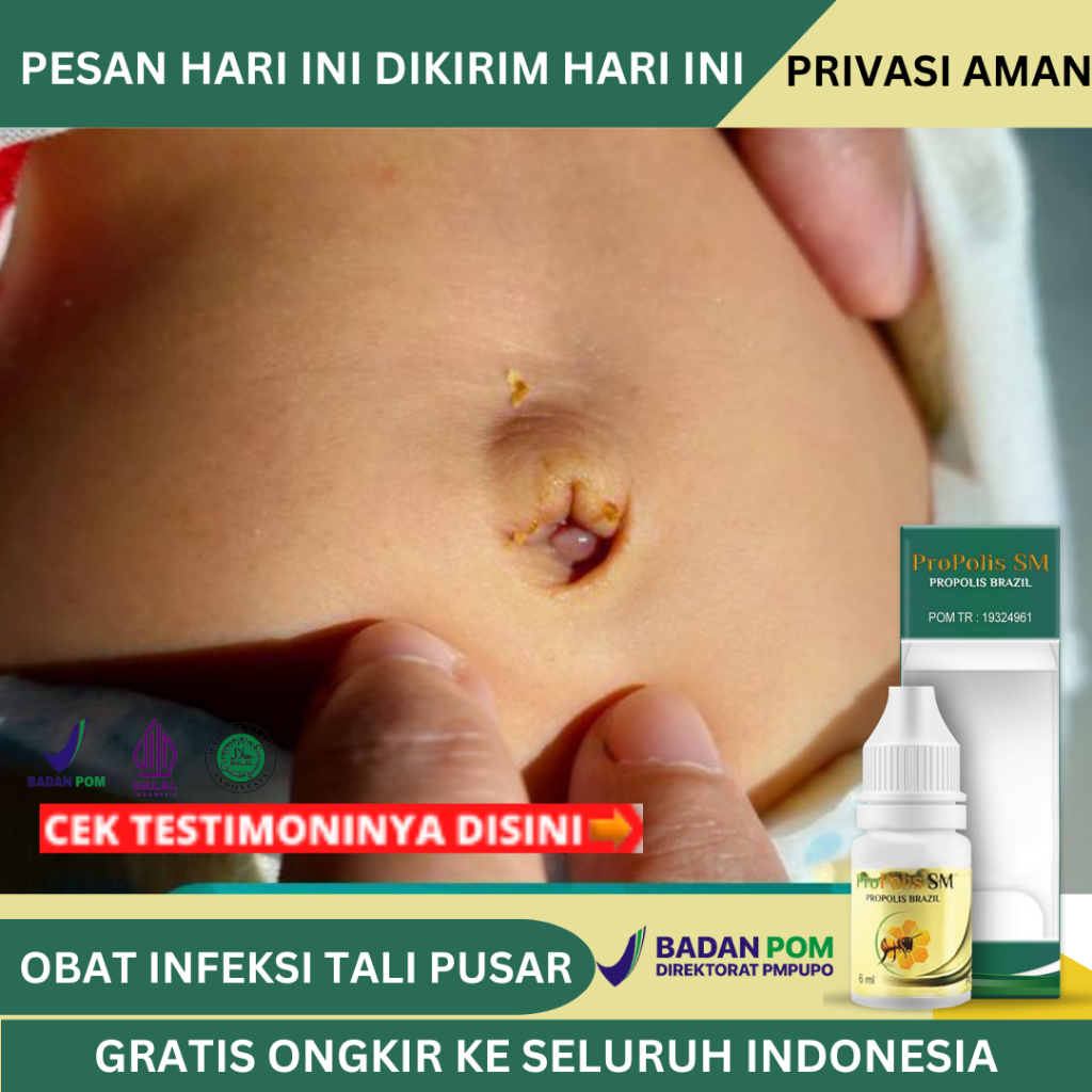 Obat Infeksi Tali Pusar, Obat Granuloma Umbilikalis, Obat Pusar Berair, Pusar Bernanah, Obat Infeksi