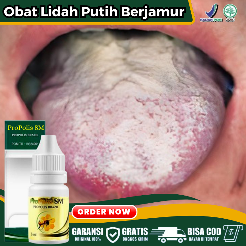 Obat Tetes Penghilang Lidah Berjamur, Lidah Putih, Lidah Terasa Pahit, Lida Bengkak, Lidah Nyeri, Li