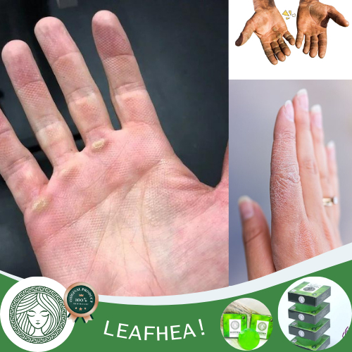 Obat Tangan Kapalan, Obat Jari Tangan Kering, Obat Telapak Tangan Kasar, Obat Tangan Pecah Kering, B