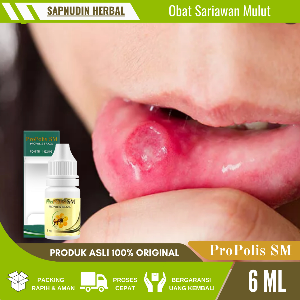 Obat Sariawan Mulut, Obat Sariawan Anak, Obat Sariawan Di Bibir, Obat Sariawan, Obat Tetes Sariawan,