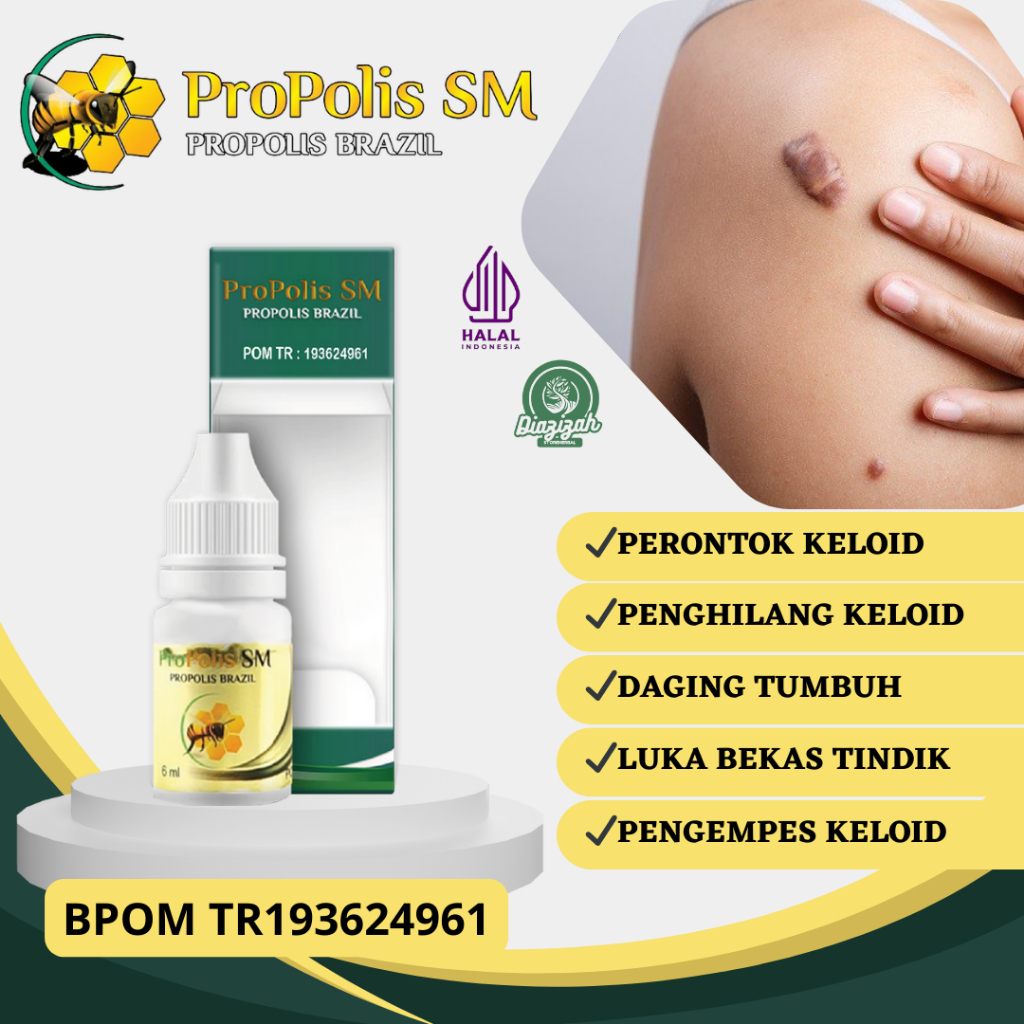 Obat Keloid, Obat Daging Tumbuh, Obat Daging Jadi, Obat Penghilang Keloid, Obat Bekas Luka Tindik, O