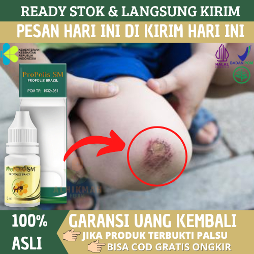 Obat Tetes Luka Di Kulit, Obat Luka Jatuh, Obat Luka Infeksi Di Kulit,  Obat Tetes Luka Agar Cepat K