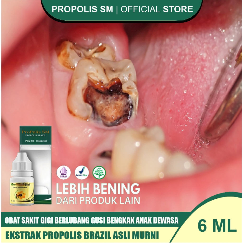 Obat Sakit Gigi Berlubang Obat Gusi Bengkak Obat Sakit Gigi Anak Dewasa Obat Sakit Gigi Kumur Propol