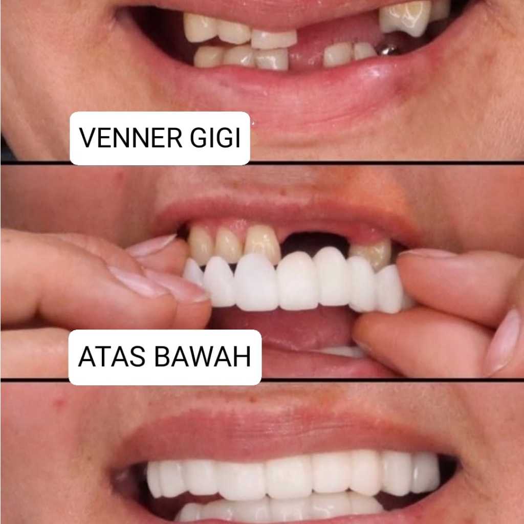 PAKET ATAS BAWAH Gigi Palsu Pengganti Gigi Ompong Veneer Berkualitas Vener Gigi palsu original penam