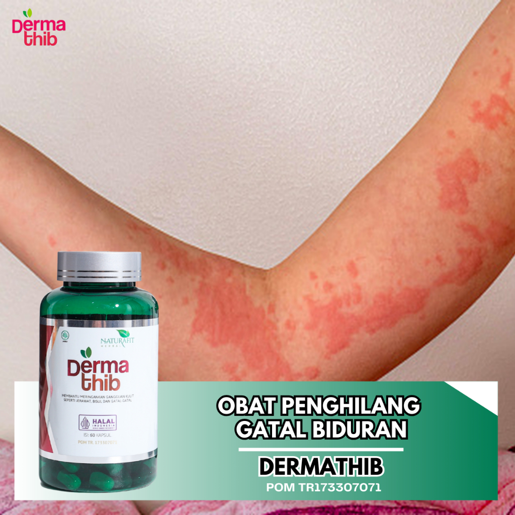Obat Gatal Kulit Alergi Dingin Biduran Gatal Alergi Herbal Bentol Kulit | DERMATHIB