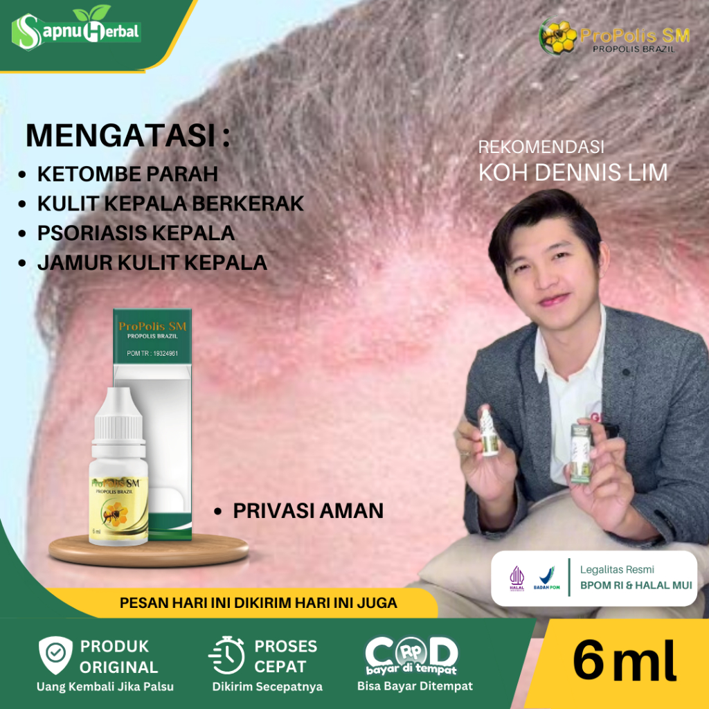 Sapnu Herbal - Obat Borok di Kepala, Psoriasis Kulit Kepala, Salep Kulit Kepala Berjamur, Gatal Bern