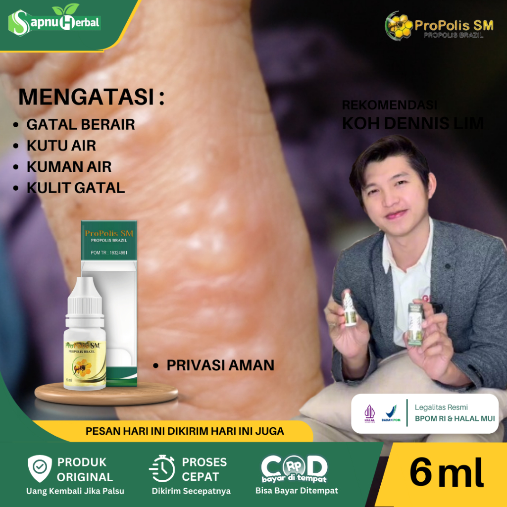 Obat Kutu Air, Penghilang Kuman Air, Gatal Berair, Kutu Air Pada Kaki, Jamur Kaki, Kutu Air Pada Sel
