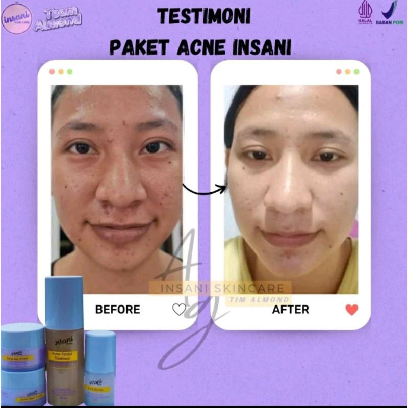 (FREE GIFT ) INSANI SKINCARE ACNE & BRIGHT GLOW BPOM & FORTE (Klinik Apoteker)