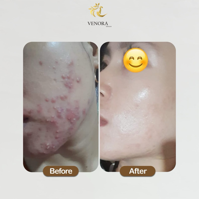 paket whitening flek venora skincare