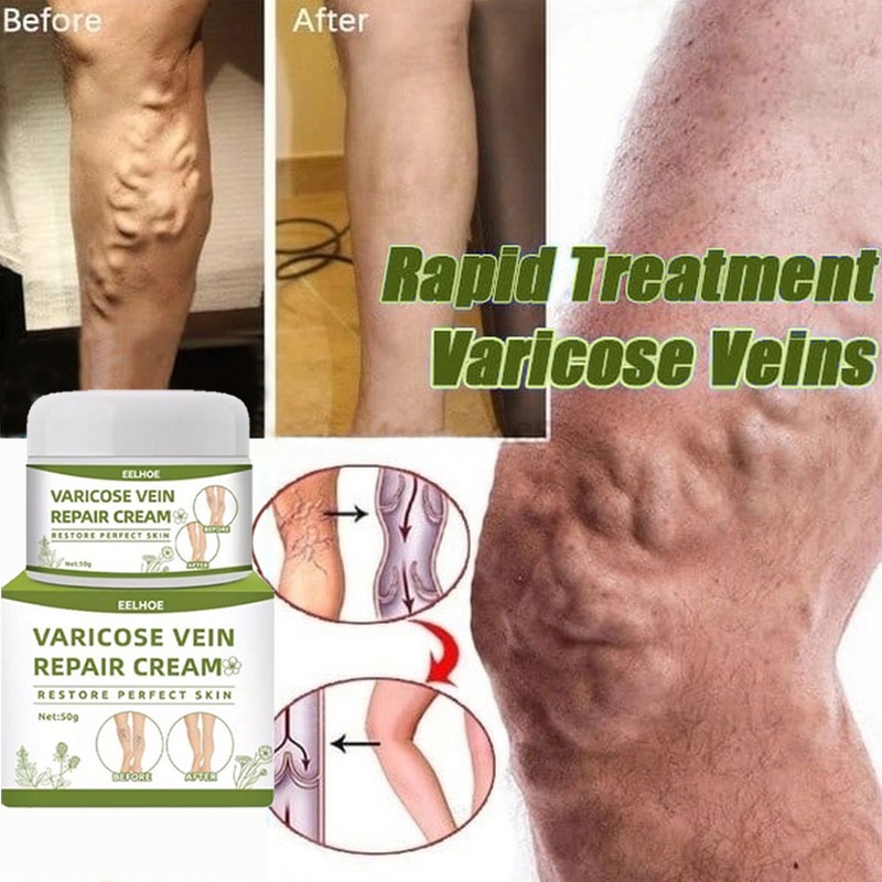 salep varises varicose vein repair cream obat varises Kaki obat untuk varises obat varises paling am