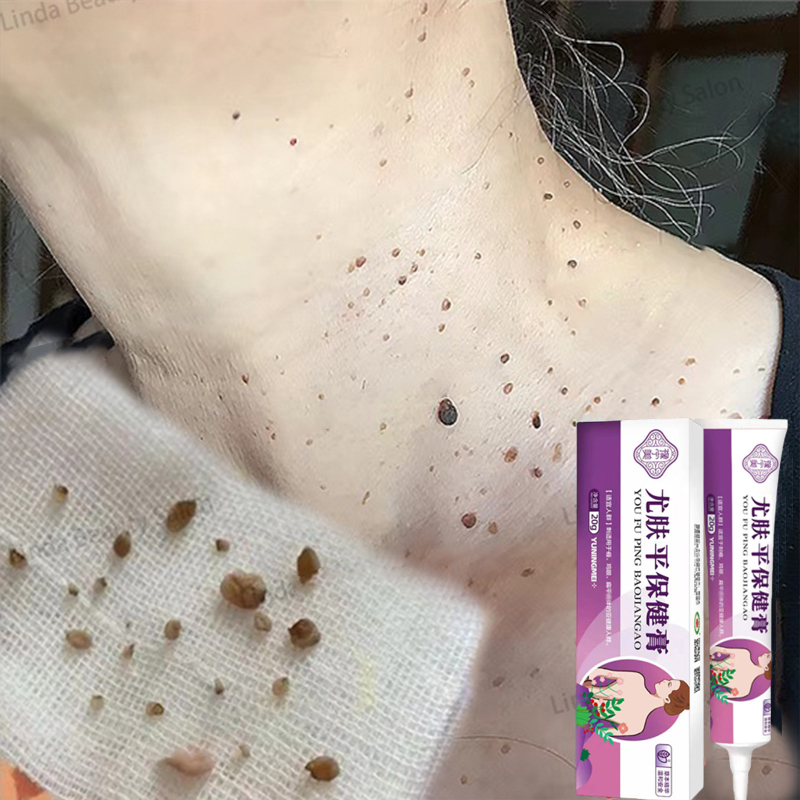 Penghilang kutil dan tahi lalat obat kutil penghilang tahi lalat 20g obat kutil obat Krim kutil skin