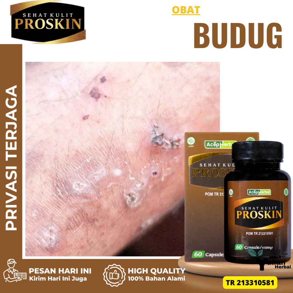 Obat Budug, Obat Penghilang Korengan, Obat Budug Borok Cenang, Obat Borok Bernanah, Obat Budug Kulit