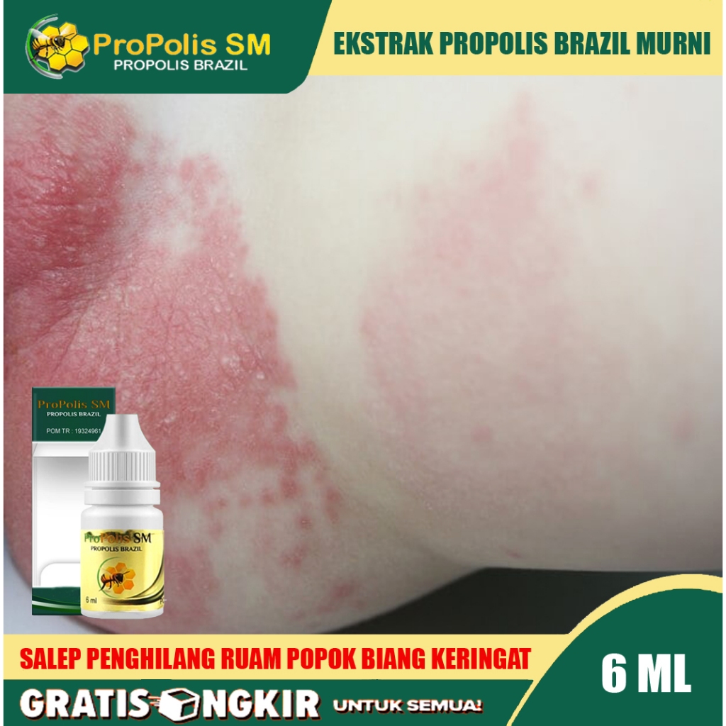 Obat Biang Keringat Untuk Bayi Anak Dewasa Obat Ruam Popok Biang Keringan Bruntusan - Propolis SM Br
