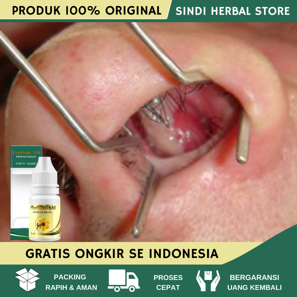Obat Polip Hidung, Benjolan Di Dalam Hidung, Daging jadi di hidung, Hidung Tersumbat, Polip Akut, Pr