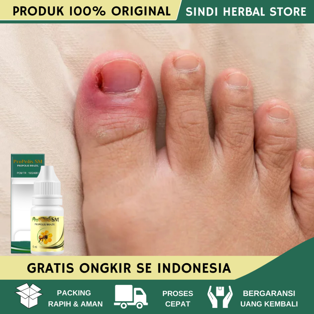 Obat Cantengan Jempol Kaki, Obat Cantengan, Obat Kuku Jamur Rusak, Obat Cantengan Tangan, Obat Cante