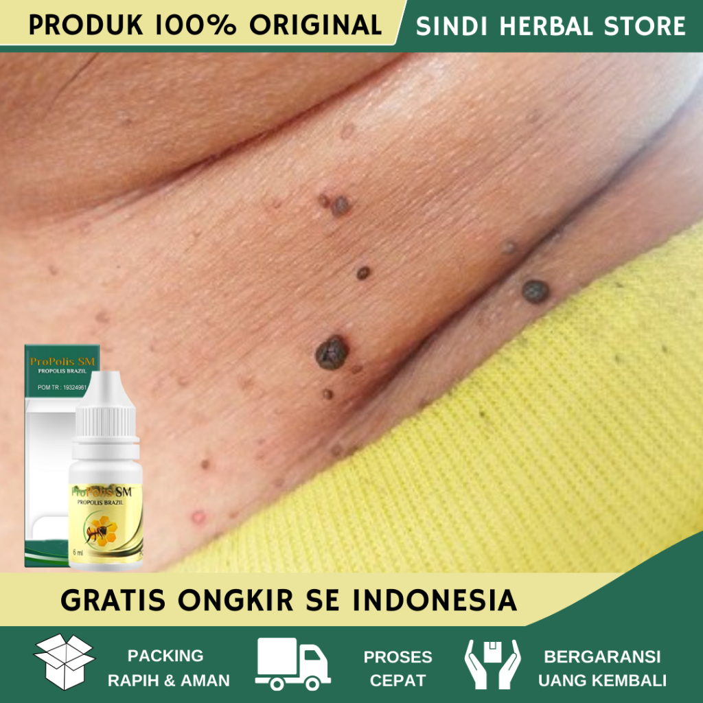 Obat Kutil Di Leher, Obat Perontok Kutil Di Leher, Obat Penghilang Kutil Di Leher, Obat Herbal Kutil