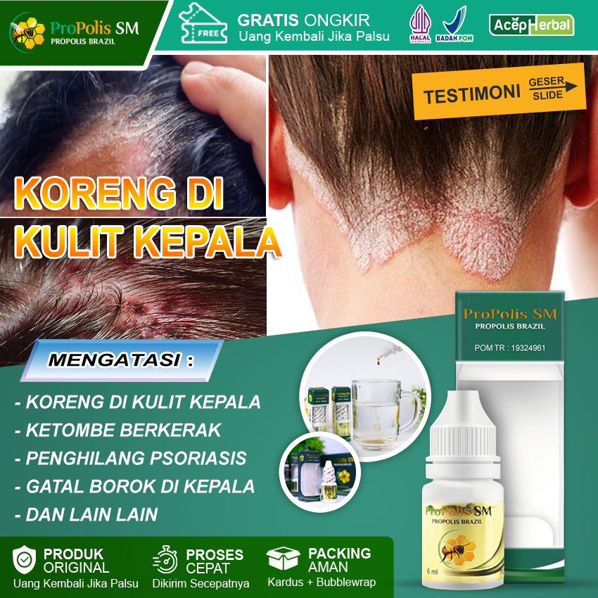 Obat Koreng di Kulit Kepala Koreng Bernanah Gatal Luka Koreng Cepat Kering Korengan Borok Psoriasis 