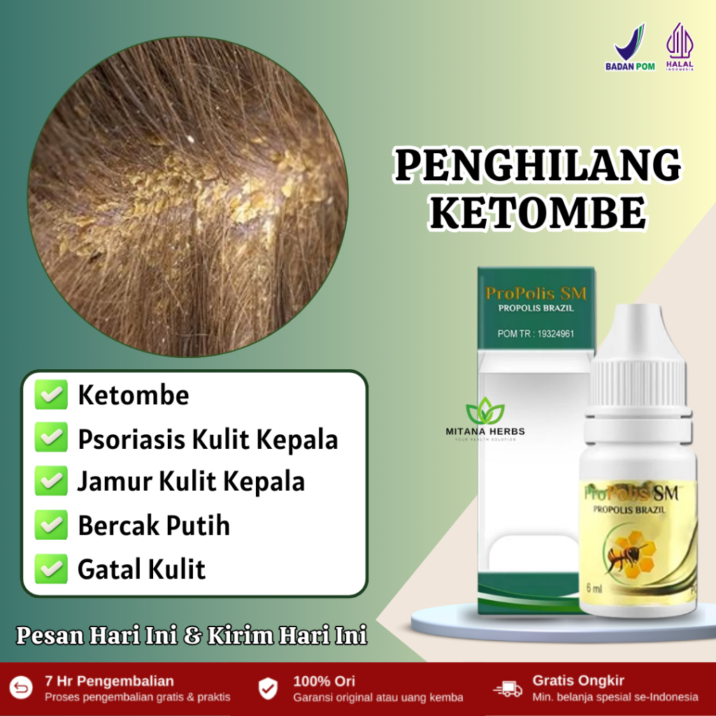 Obat Penghilang Ketombe Parah, Psoriasis Kulit Kepala, Infeksi Jamur Kulit Kepala, Kulit Kepala Bers