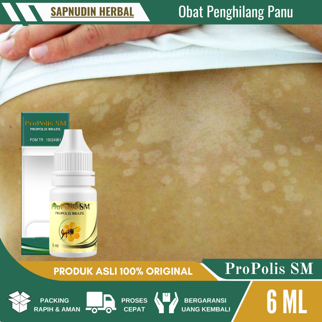 Obat Untuk Panu Kadas Kurap, Obat Panu Di Wajah, Obat Panu Di Pipi, Obat Panu Di Punggung, Obat Panu