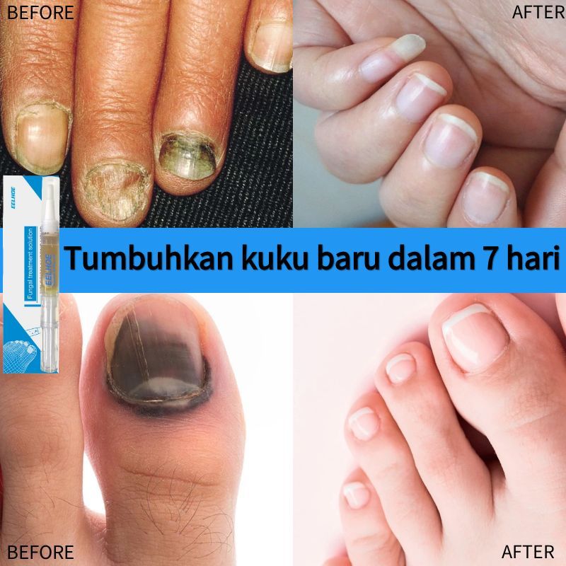 Obat jamur kuku Obat kuku jamur dan rusak Penghilang Jamur Kuku Gel Anti Infeksi Obat Kuku Rusak Pem