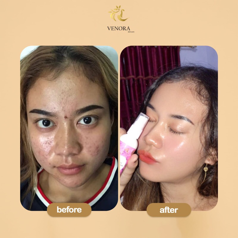 ACNE NIGHT CREAM / CREAM MALAM VENORA SKINCARE (MEMBERSIHKAN JERAWAT)