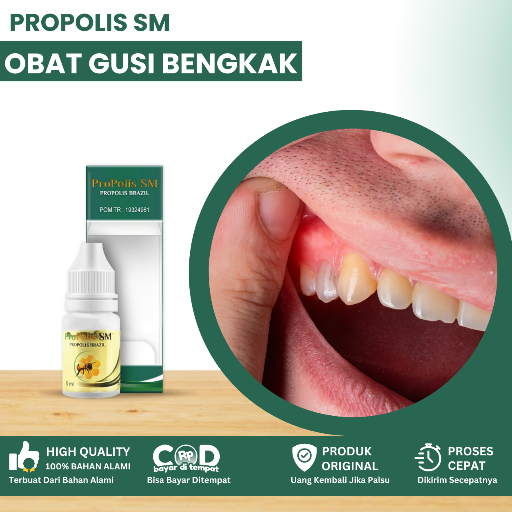 Obat Gusi Bengkak, Gusi Sakit, Obat Radang Gusi, Gingivitis, Obat Akar Gusi Memerah, Benjolan Di Gus