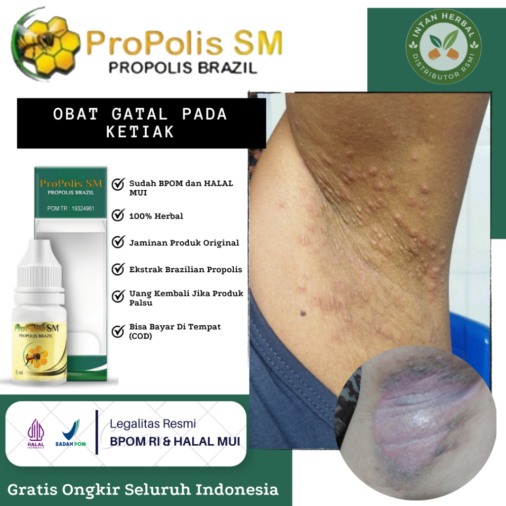 Obat Gatal Ketiak, Iritasi Ketiak, Benjolan di Ketiak, Jamur di Ketiak, Eksim Ketiak, Ketiak Hitam, 