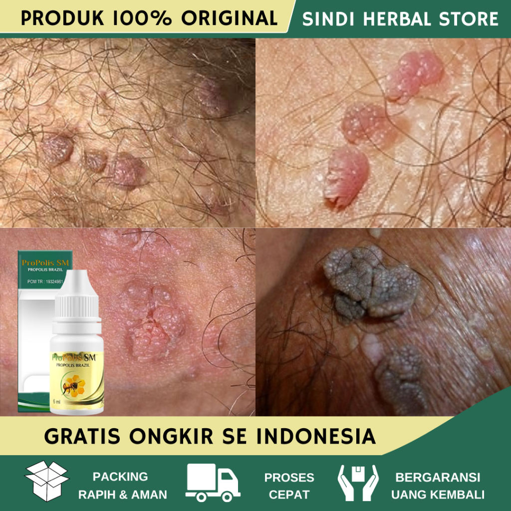 Obat Perontok Kutil Kelamin - Penghilang Kutil Kelamin - Bintik-Bintik Pada Kelamin Pria Dan Wanita 