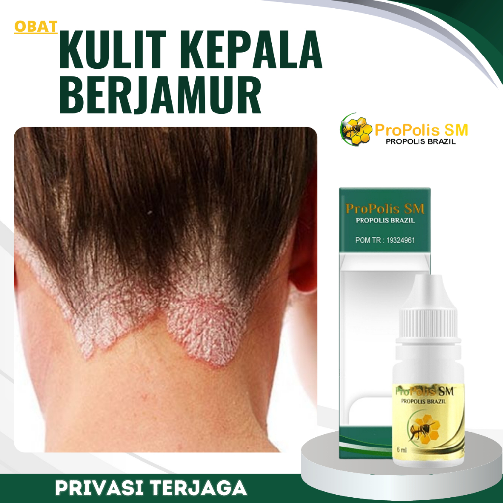 Obat Kulit Kepala Berjamur, Obat Penghilang Kulit Kepala Jamuran, Obat Borok Kulit Kepala, Obat Keto