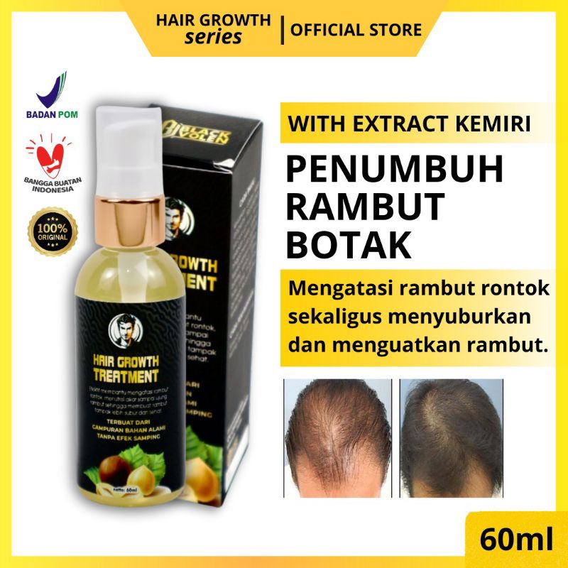 Penumbuh Rambut Botak dan Rontok Penumbuh Rambut Botak Wanita Penumbuh Rambut Botak Pria Hair Growth