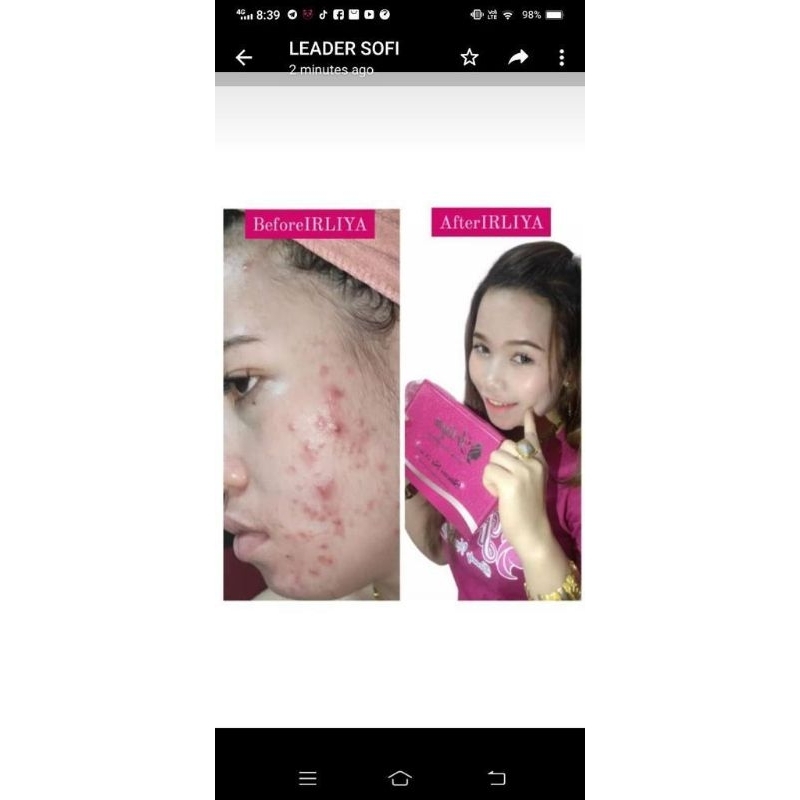 SKINCARE IRLIYA BEAUTY MENGATASI JERAWAT PARAH DAN WAJAH KUSAM