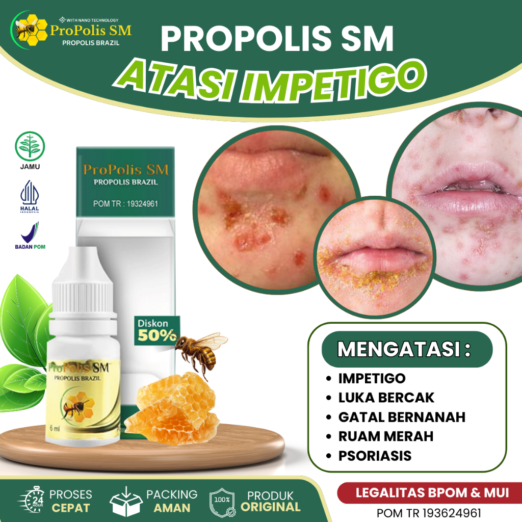 Obat Gatal Impetigo Pada Anak Dan Dewasa, Obat Infeksi Kulit, Obat Gatal Ruam Merah Pada Wajah, Obat