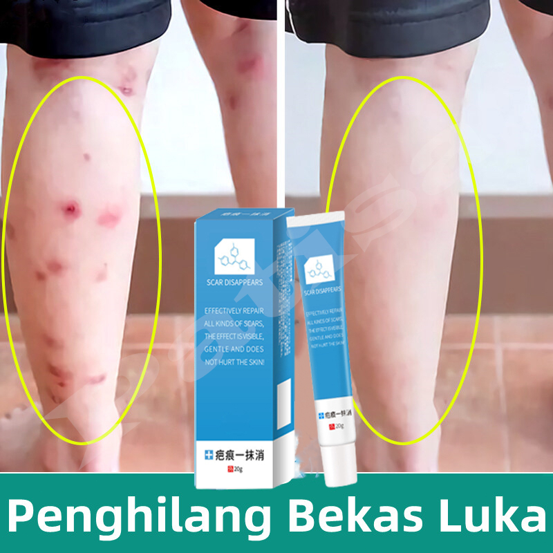 COD penghilang bekas luka lama/Penghilang Bekas Luka/penghilang bekas luka koreng hitam/salep penghi