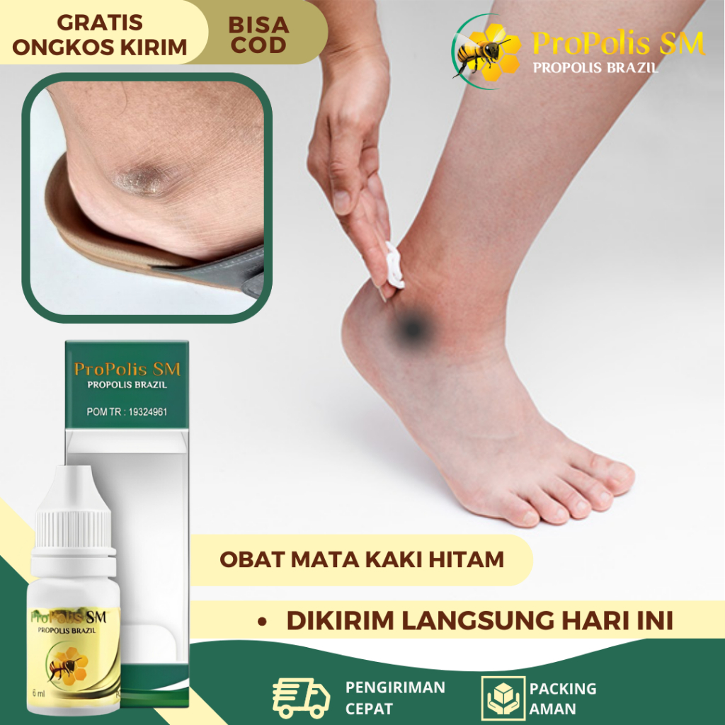 Obat Mata Kaki Hitam, Obat Pemutih Mata Kaki Yang Hitam, Salep Cair Mata Kaki Hitam & Kasar, Obat Ma