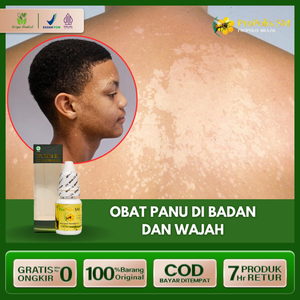 Obat Panu Obat Penghilang Hapur Kulit kurap Kudis bercak putih di kulit wajah dan badan Propolis SM