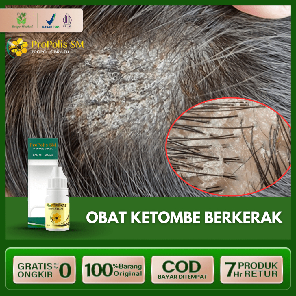 Obat Ketombe Berkerak Obat Oles Ketombe Parah Bersisik Tinea Capitis Ketombe Gatal Menahun