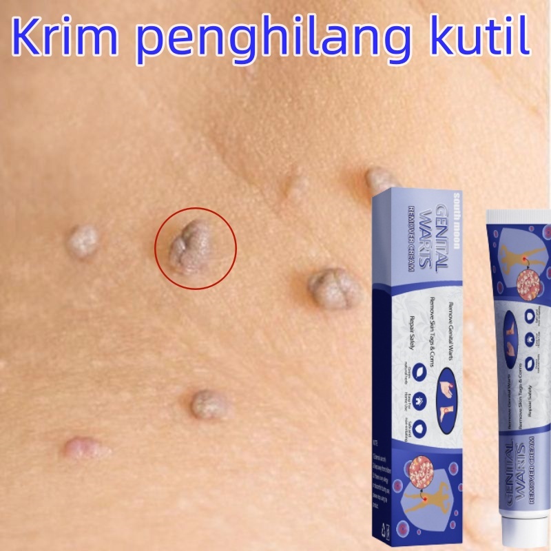 penghilang tahi lalat penghilang kutil dan tahi lalat  Mengobati HPV Tanpa rasa sakit dan tanpa efek