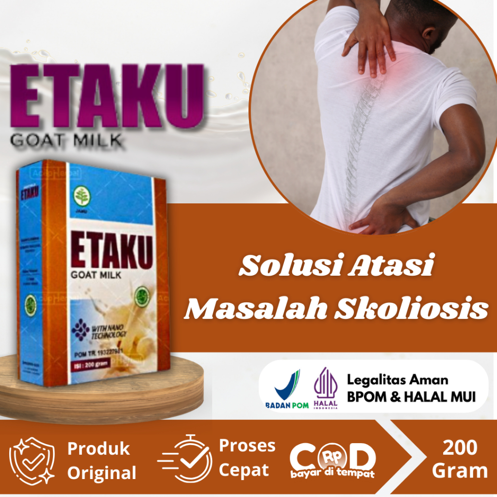 Susu Untuk Skoliosis, Tulang Bengkok, Gangguan Tulang Belakang, Tulang Punggung Bengkok Bergeser, Sa