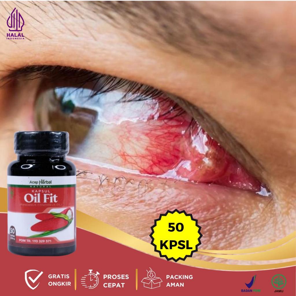 Obat Mata Berlemak, Obat Mata Berlemak Kekuningan, Obat Mata Kuning Penyakit Glukoma, Obat Pterygium