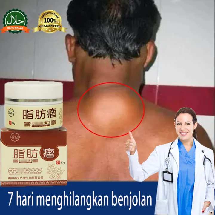 Lipoma Cream,Krim lipoma,Obat Benjolan Herbal Lipoma,OBAT OLES PENGHILANG BENJOLAN LIPOMA DI TANGAN,