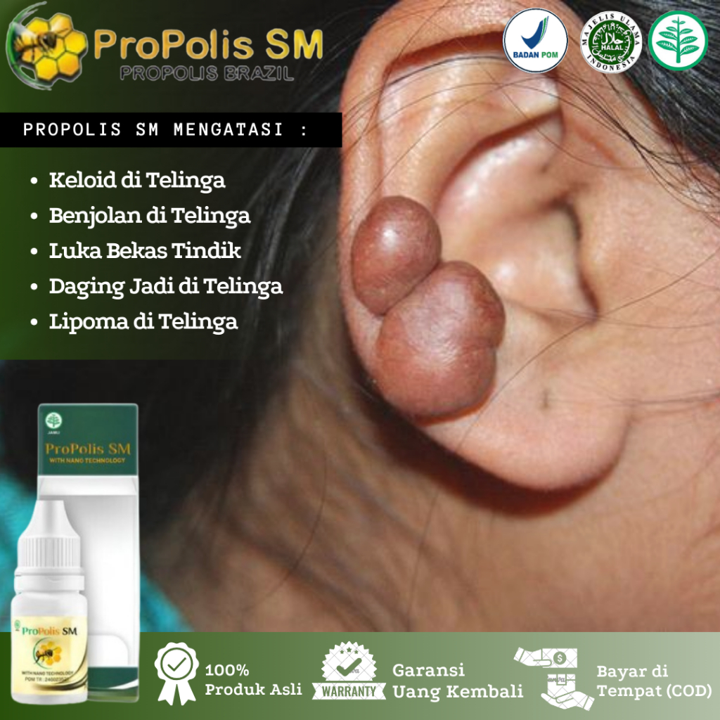 Obat Keloid DI Telinga, Benjolan di Belakang Telinga, Keloid Bekas Luka Tindik, Daging Tumbuh di Tel