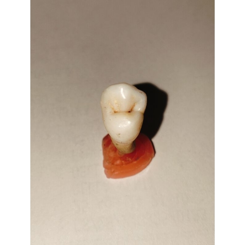 Gigi asli premolar 14