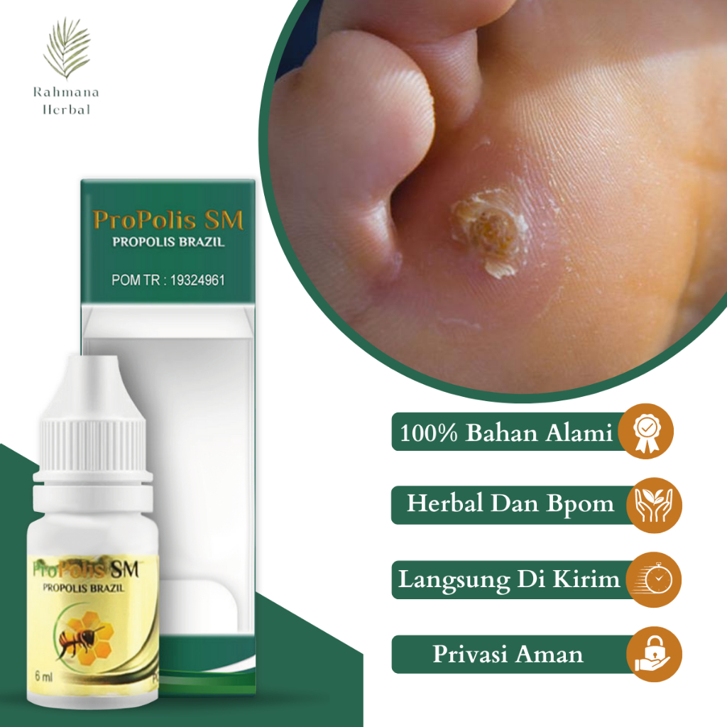 Obat Mata Ikan, Obat Mata Ikan Telapak Kaki Tangan, Obat Kaki Rayapan, Obat Kaki Bolong Bolong, Obat