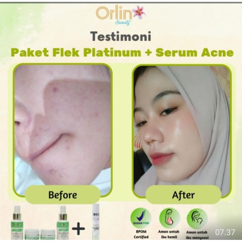 Orlin Beauty flek platinum