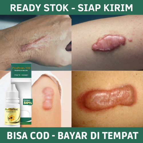 Obat Keloid, Obat Keloid Daging Tumbuh, Obat Keloid Menahun, Obat Penghilang Keloid Daging Tumbuh, O
