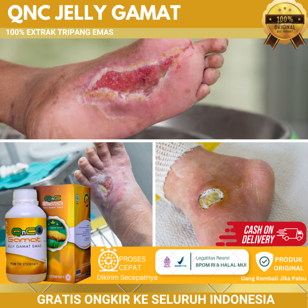 Obat Luka Diabetes, Luka Diabetes Basah, Diabetes Melitus, Diabetes Kering, Luka Diabetes Bernanah, 
