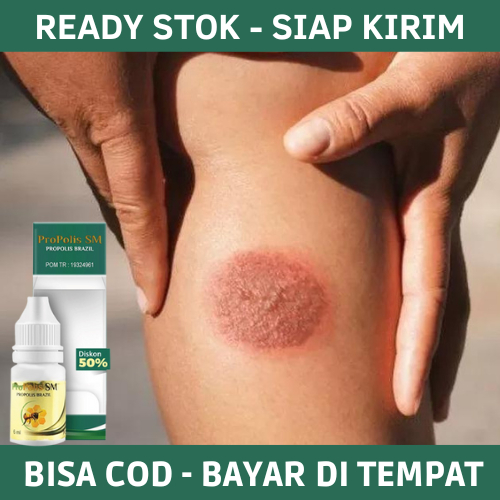 Obat Koreng Di Kaki, Obat Korengan, Obat Penghilang Koreng, Obat Koreng Bernanah, Obat Penghilang Be