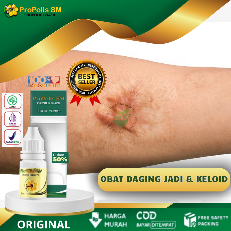 Obat Penghilang Keloid, Obat Keloid Menonjol Tahunan, Obat Menghilangkan Keloid Menahun, Obat Daging