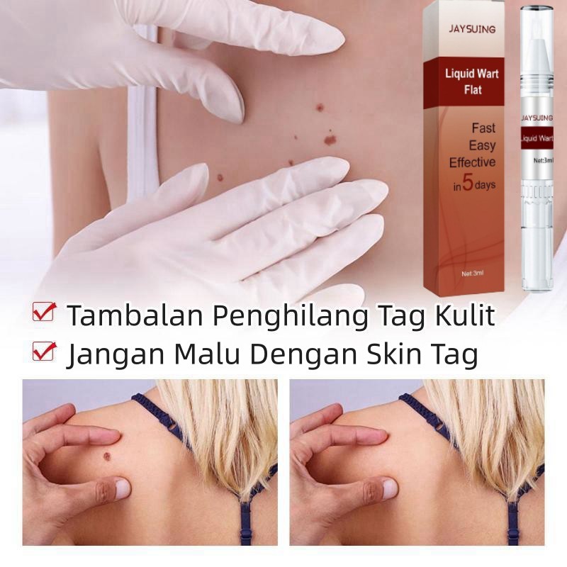 Penghilang kutil wart remover pen Penghilang Tahi Lalat Penghilang Kutil Skin Tag Remover Menghilangkan Tahi Lalat