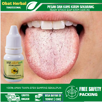 Obat Radang Lidah, Obat Lidah Putih, Obat Lidah Berjamur, Lidah Pecah Pecah, Sariawan Lidah, Obat Li